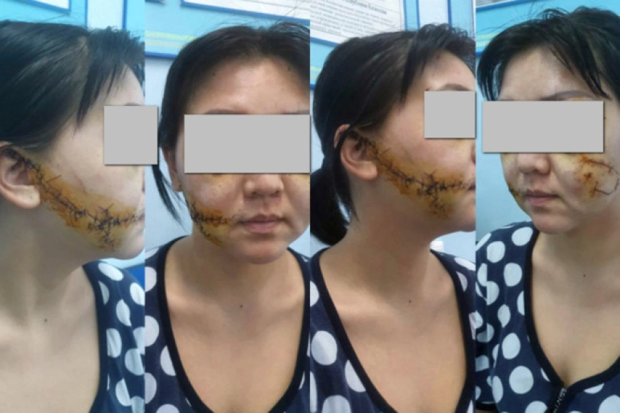 Жительница Актобе простила мужа, изрезавшего ей лицо: суд поступил иначе 